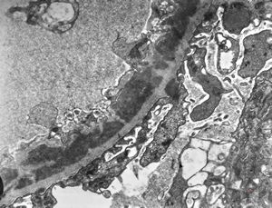 M,37y. | type I membranoproliferative glomerulonephritis (mesangiocapillary)